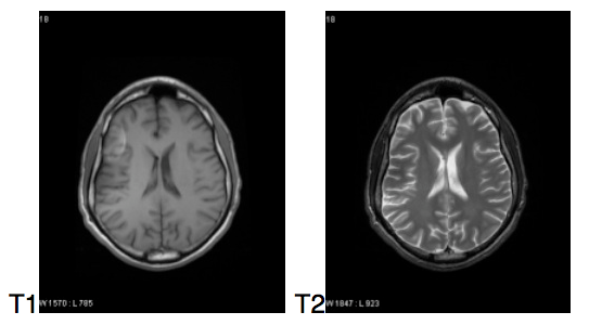 barone-mnemonic-mri-t1-verses-t2